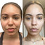 ChinFix: Liposuction