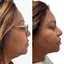 ChinFix: Liposuction