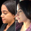 ChinFix: Liposuction