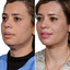 ChinFix: Liposuction