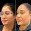 ChinFix: Liposuction