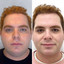 ChinFix: truSculpt iD
