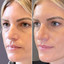 EyeFix: Upper Blepharoplasty