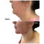 FaceFix: M-Lift