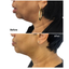 FaceFix: M-Lift