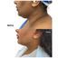 FaceFix: M-Lift