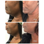 FaceFix: M-Lift
