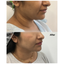 FaceFix: M-Lift
