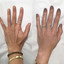 HandFix: Filler