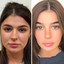 JawlineFix: Masseter Botox