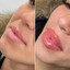 LipFix: Filler