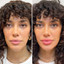 LipFix: Filler