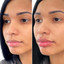 LipFix: Filler