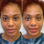 LipFix: Filler