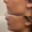 LipFix: LipFlip