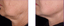 Microneedling