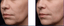 Microneedling
