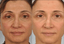 Microneedling