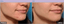 Microneedling