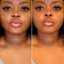 NeckFix: Filler