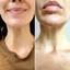 NeckFix: Nefertiti Lift