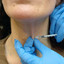 NeckFix: Nefertiti Lift