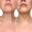 NeckFix: Platysmal Bands