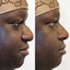 NoseFix: Filler