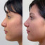 NoseFix: Filler