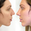 NoseFix: Filler