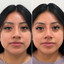 NoseFix: Slimming