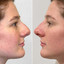 NoseFix: Slimming