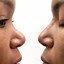 NoseFix: Slimming