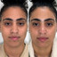 SkinFix: Dermaplaning