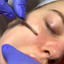 SkinFix: Dermaplaning