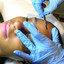 SkinFix: Dermaplaning
