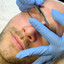 SkinFix: Dermaplaning