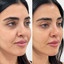 SkinFix: Hydrafacial