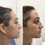 SkinFix: Hydrafacial