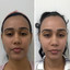 SkinFix: Hydrafacial