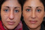 SkinFix: IPL