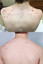 SkinFix: IPL