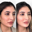 SkinFix: Microneedling