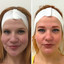 SkinFix: Microneedling