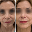 SkinFix: Microneedling