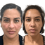 SkinFix: VI Peel