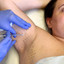 SweatFix: Botox