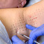 SweatFix: Botox
