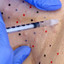 SweatFix: Botox