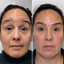 WrinkleFix: Botox (Existing Customers)